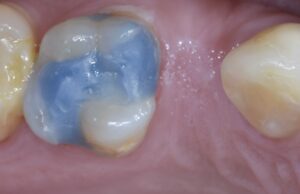 インプラントフラップレス治療 初診時