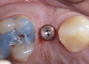 インプラントフラップレス治療 術直後