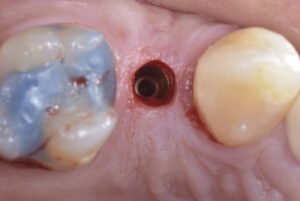 インプラントフラップレス治療 術中