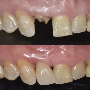 前歯部インプラント治療