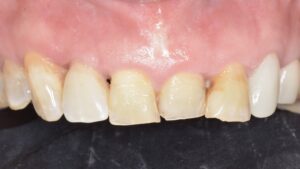 前歯部インプラント 最終補綴