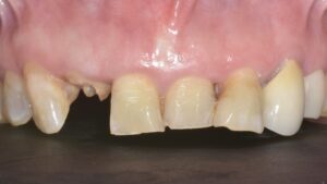 前歯部インプラント治療 初診時