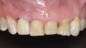 前歯部インプラント 抜歯即時埋入 仮歯装着