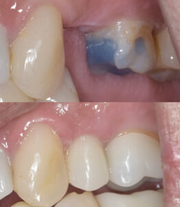 インプラントフラップレス補綴後