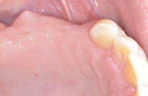 奥歯インプラン