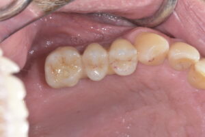 奥歯インプラント