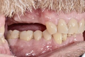 奥歯インプラント