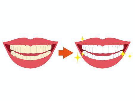 Illustration of teeth whitening: a before-and-after showing darkened teeth on the left and sparkling white teeth on the right with an arrow between them