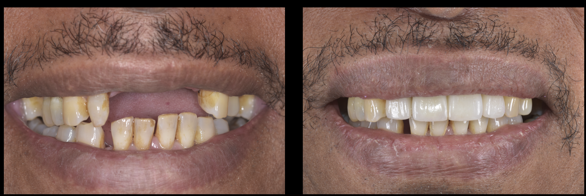 インプラント　骨造成