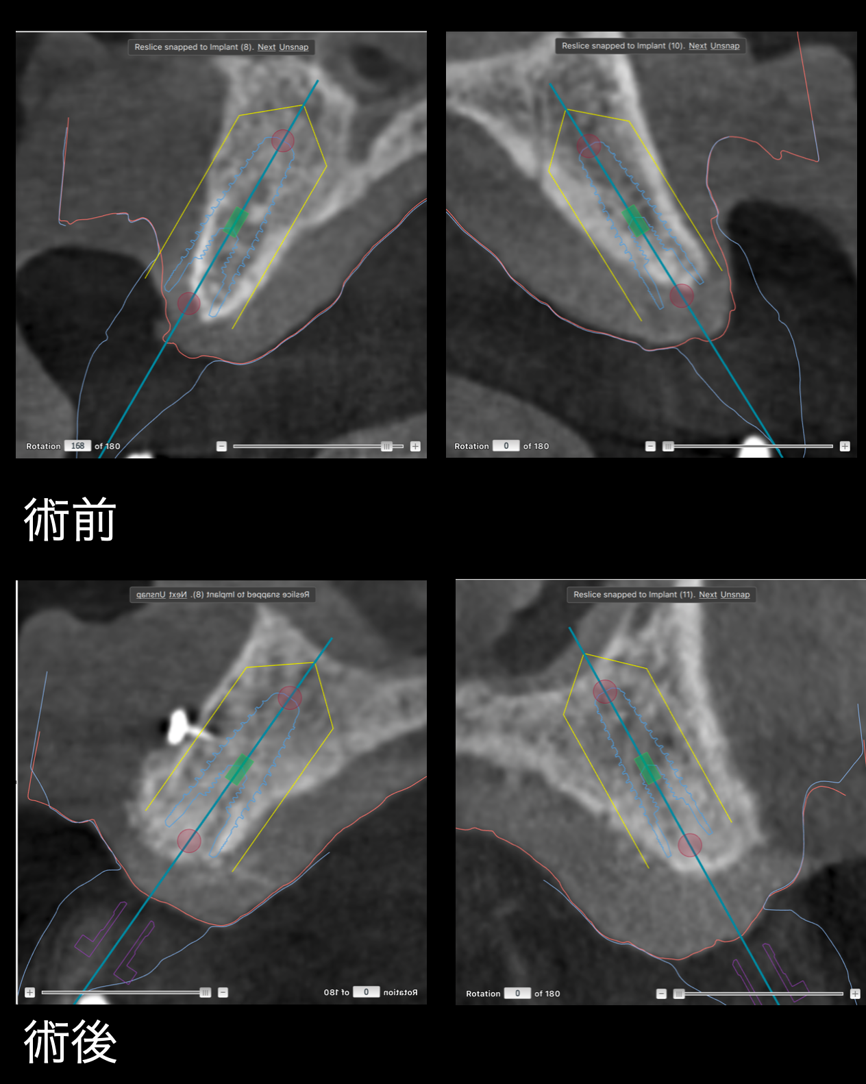 骨造成　CBCT