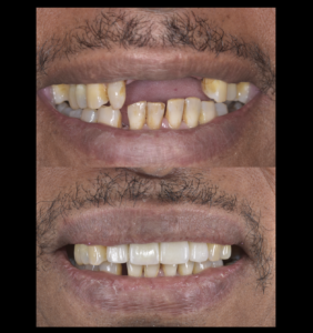 インプラント　骨造成