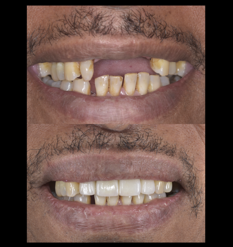 インプラント　骨造成