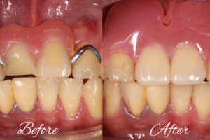 Side-by-side before and after photos of upper and lower teeth: left shows crowding and a metal orthodontic wire; right shows straightened teeth and healthier gums.