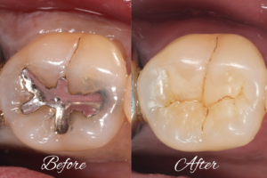 Before and after showing a molar with a large metal restoration and decay (left) and a natural-looking, repaired tooth (right).