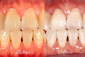 Side-by-side view of a mouth showing 'Before' (yellowish, crowded front teeth) and 'After' (whiter, straighter front teeth) results.