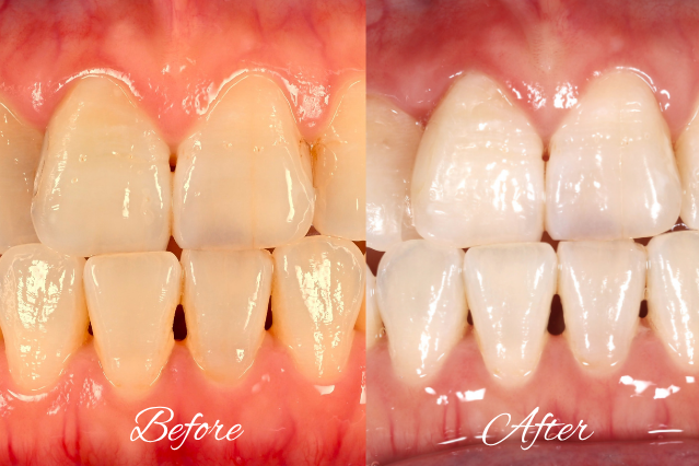 Side-by-side view of a mouth showing 'Before' (yellowish, crowded front teeth) and 'After' (whiter, straighter front teeth) results.