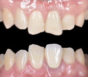 Close-up of upper and lower front teeth showing misalignment and gaps with pink gums behind them