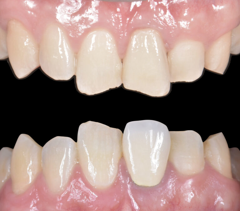 Close-up of upper and lower front teeth showing misalignment and gaps with pink gums behind them