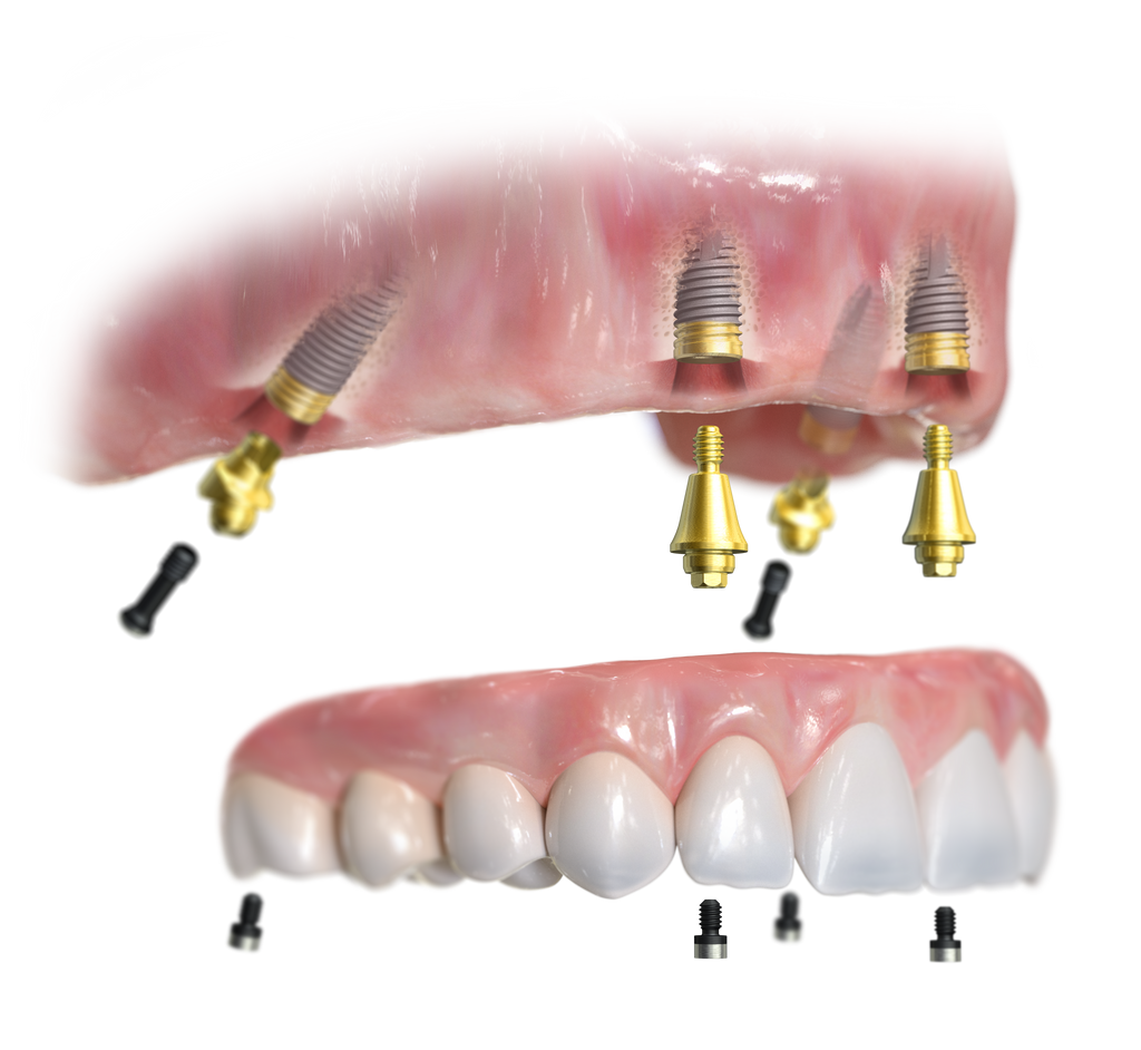 Dental implant diagram: upper gum with multiple implants and abutments, and a lower set of natural-looking teeth ready for crowns.