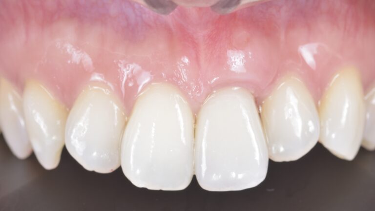 Close-up of lower front gums with white patchy lesions on the mucosa.