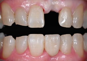 Close-up of upper front teeth showing a missing central incisor with exposed gum tissue and a small wound; lower teeth visible below.