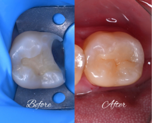 Split image of a molar before and after dental restoration: left shows cavity prep with a rubber dam; right shows a smooth, restored tooth surface.